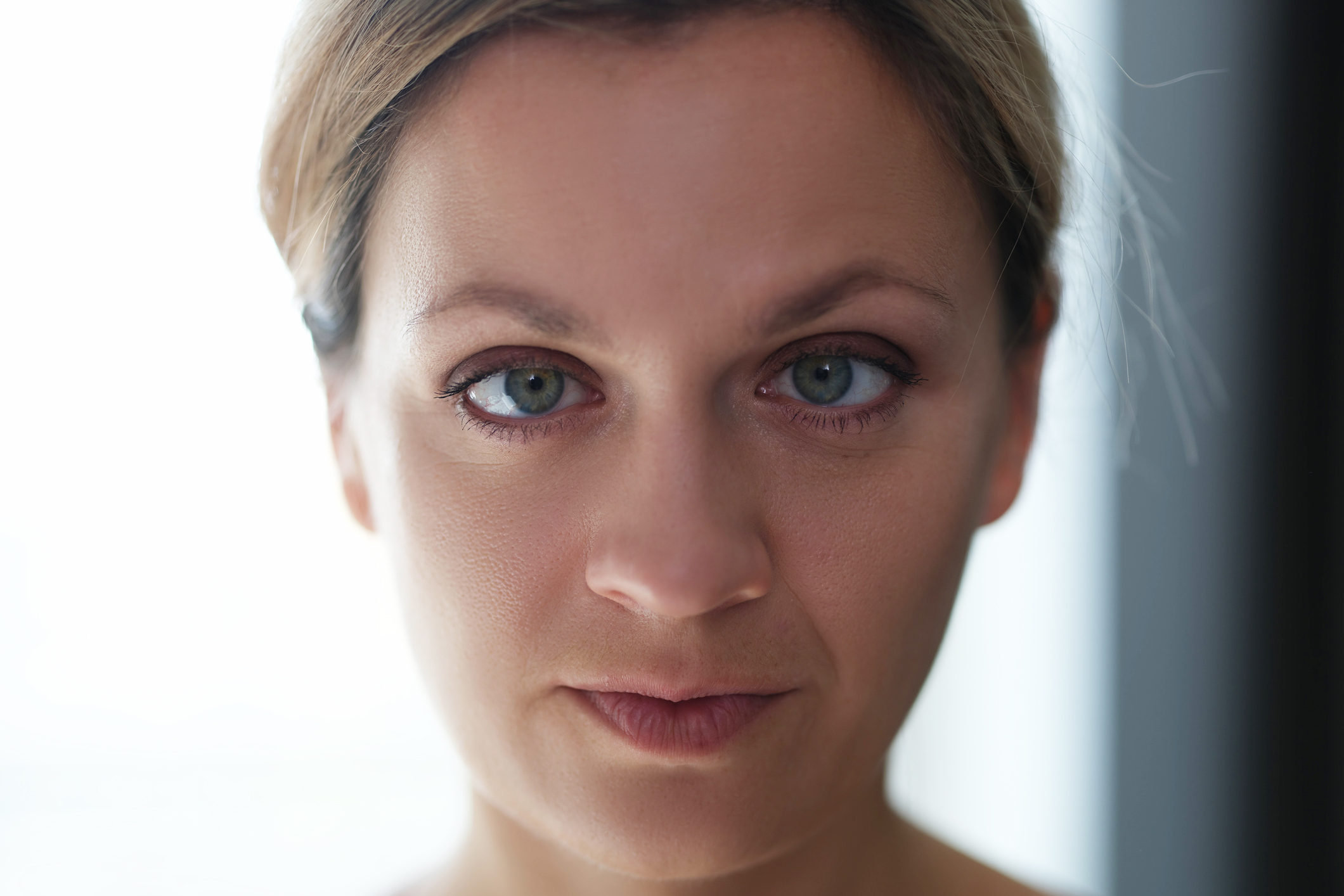 Skelning (strabismus)